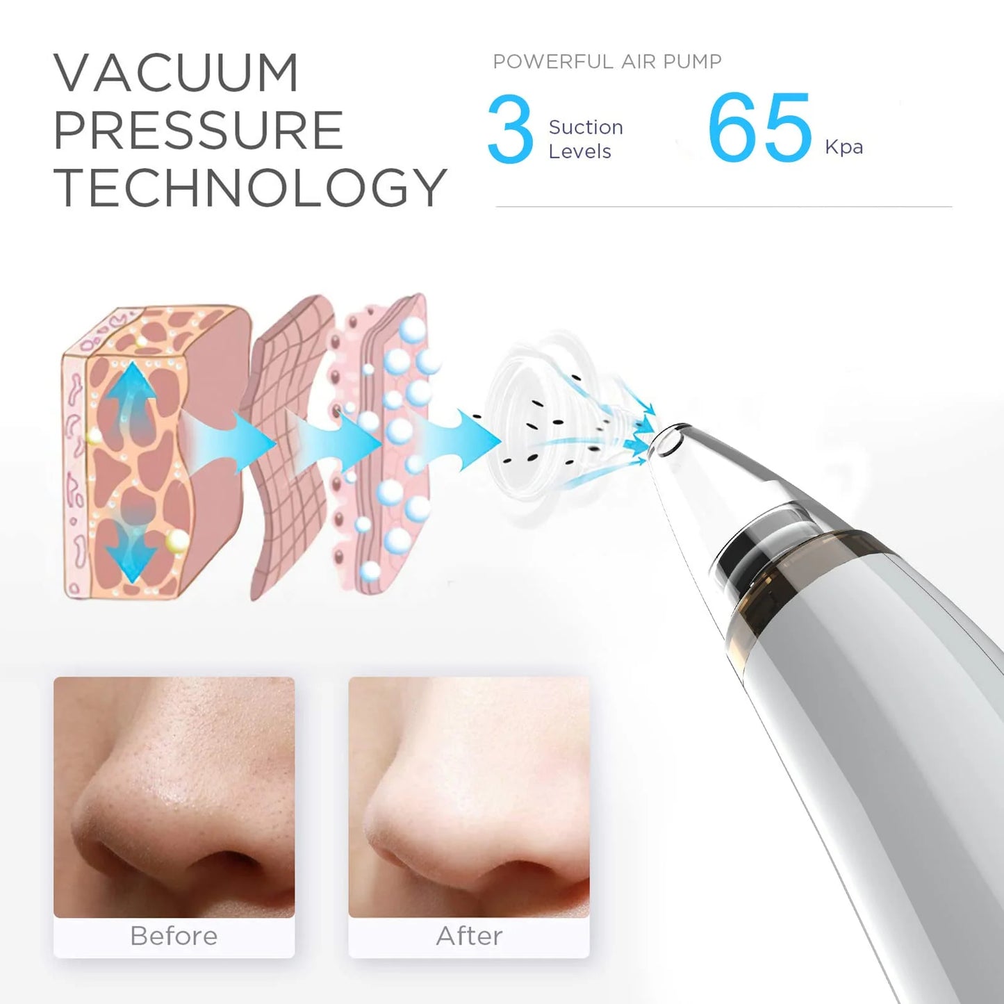 Blackhead Remover Pore Vacuum Cleaner - Electric USB Extractor with 5 Probes - White