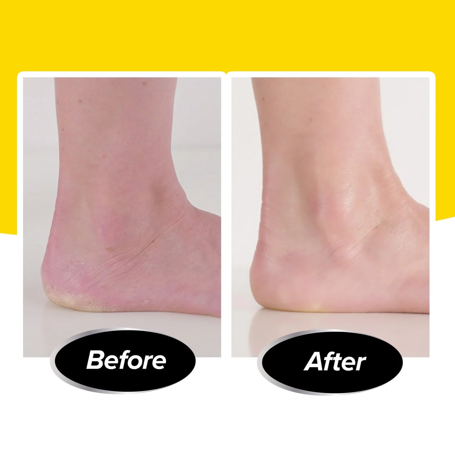 Ped Egg Pedi Vac - Callus Remover for Feet with Built-In Vacuum Removes Dead Skin from Feet with 2000 Rpms - Electric Callus Remover Sucks up Shavings for Mess-Free Exfoliation