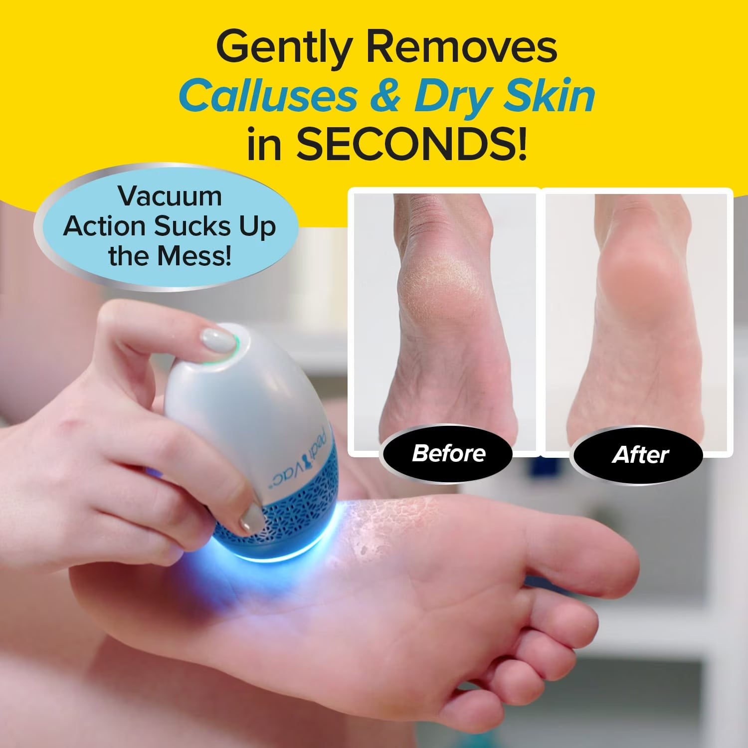 Ped Egg Pedi Vac - Callus Remover for Feet with Built-In Vacuum Removes Dead Skin from Feet with 2000 Rpms - Electric Callus Remover Sucks up Shavings for Mess-Free Exfoliation