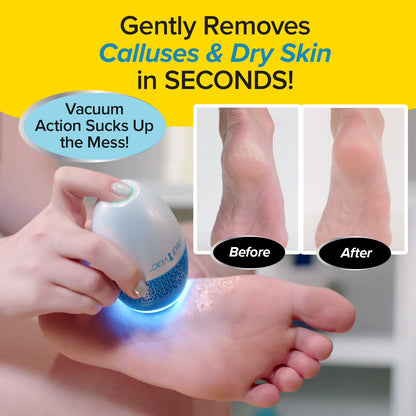 Ped Egg Pedi Vac - Callus Remover for Feet with Built-In Vacuum Removes Dead Skin from Feet with 2000 Rpms - Electric Callus Remover Sucks up Shavings for Mess-Free Exfoliation