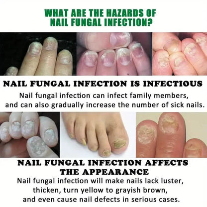 Ginger Nail Care Liquid Onychomycosis Fungus Repair Hand and Foot Nail Care